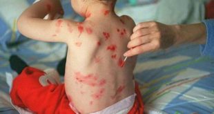 Casos de varicela